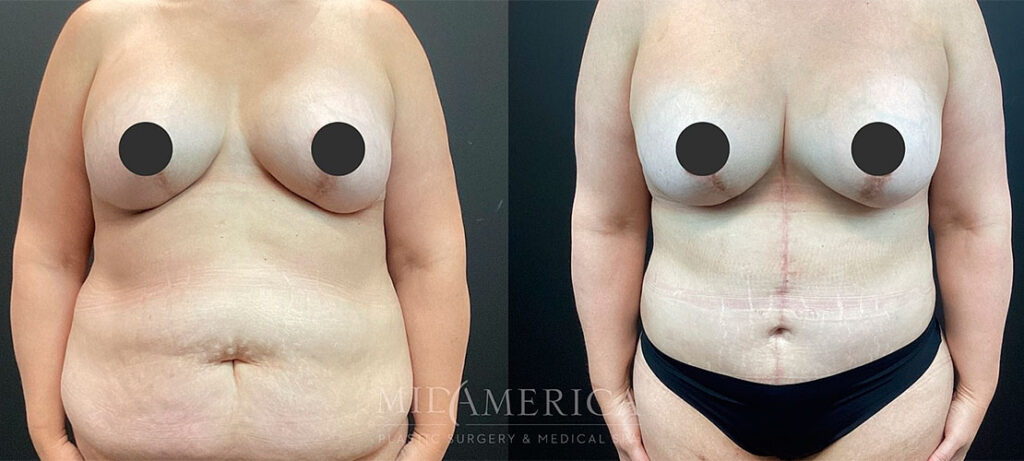 Tummy tuck before and after - photos by MidAmerica Plastic Surgery & Medical Spa