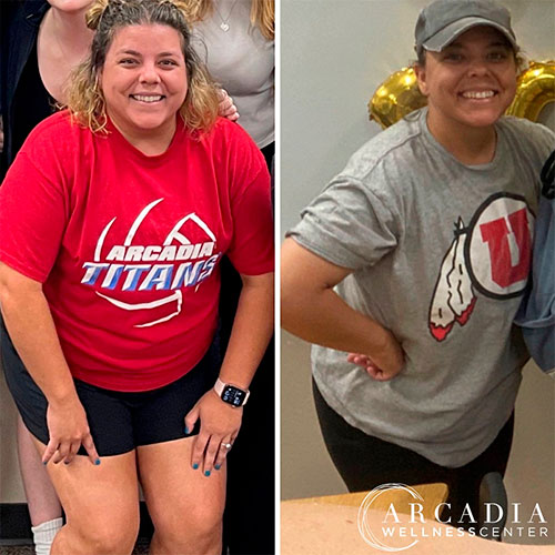 Semaglutide before and after - photos by Arcadia Wellness Center