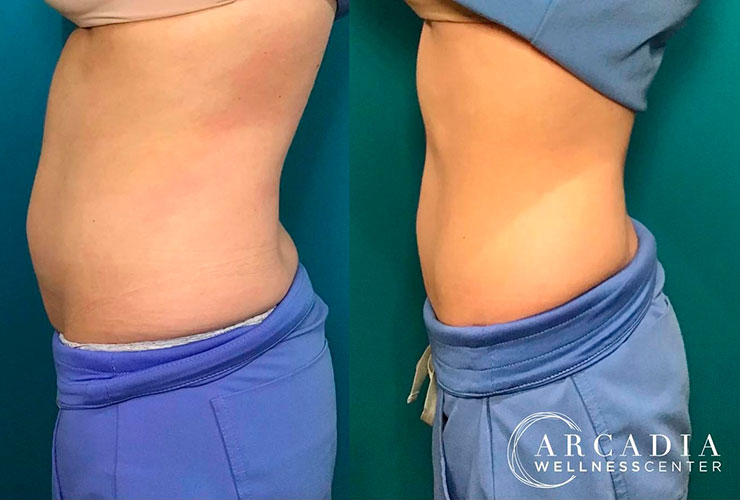 semaglutide wellness clinic Semaglutide Before and After Photos: Weight Loss Results