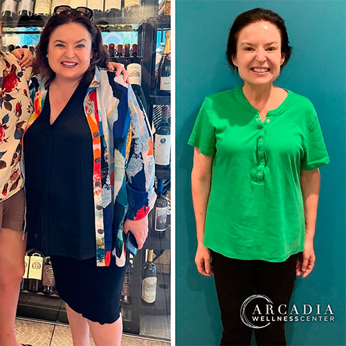 Semaglutide before and after - photos by Arcadia Wellness Center