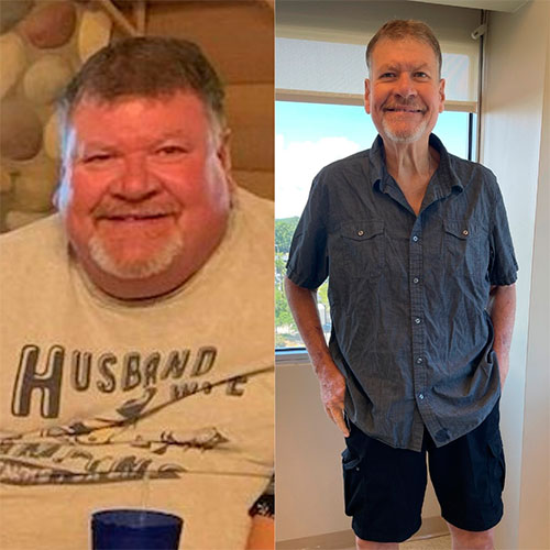 Duodenal switch before and after - photos by MASJax