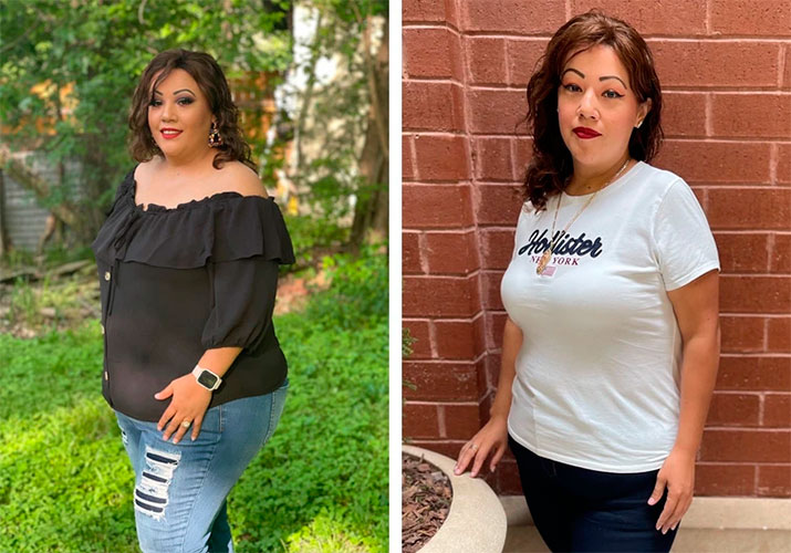 SADI-S surgery before and after - photo by NOVA Bariatrics & General Surgery