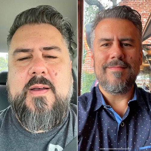 Weight loss program before and after - photos by Texas Weight Loss