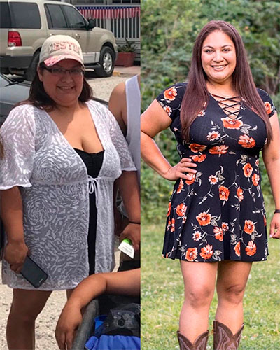 Weight loss program before and after - photos by Texas Weight Loss