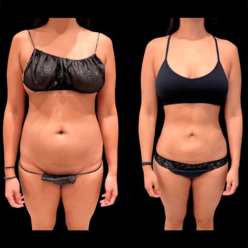 Lipo 360 before and after - photos by Neinstein Plastic Surgery