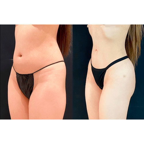 Lipo 360 before and after - photos by Neinstein Plastic Surgery