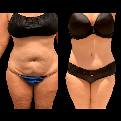 Lipo 360 before and after - photos by Neinstein Plastic Surgery