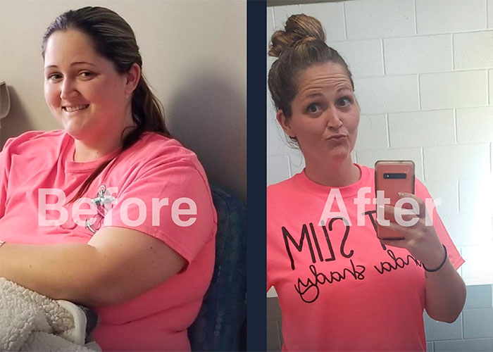 Bariatric surgery before and after - photos by New Life Surgical Associates