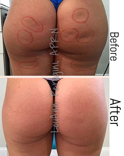 Morpheus8 body before and after - photos by Biorestoration Medical + Aesthetics
