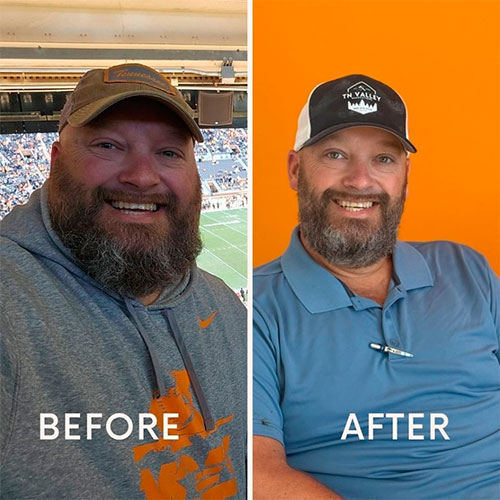 Bariatric surgery before and after - photos by New Life Center for Bariatric Surgery
