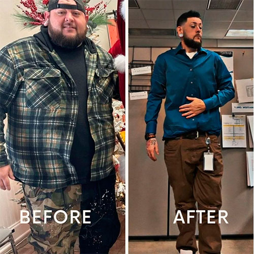 Bariatric surgery before and after - photos by New Life Center for Bariatric Surgery