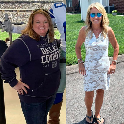 Bariatric surgery before and after - photos by New Life Center for Bariatric Surgery