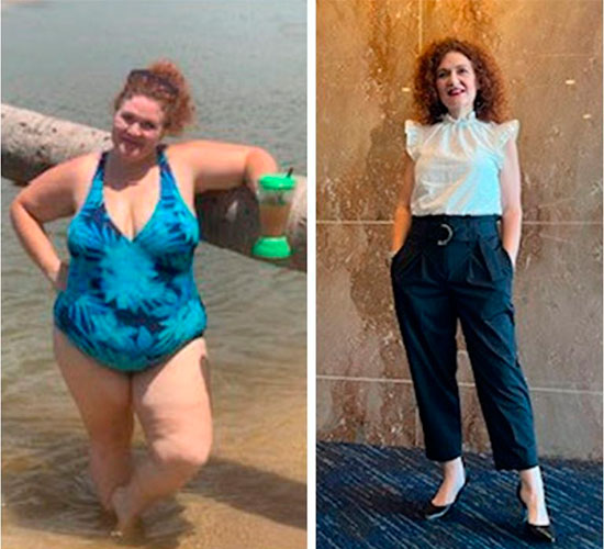Bariatric surgery before and after - photos by New Life Center for Bariatric Surgery