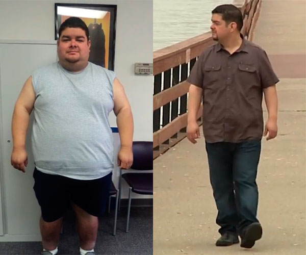 Bariatric surgery before and after - photos by Henry Ford Health